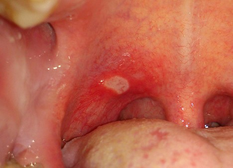 No More Suffering: Learn How to Effectively Treat Canker Sores