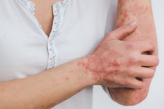 Beyond Skin Deep: Understanding the Complexities of Psoriasis Causes, Symptoms, and Treatments