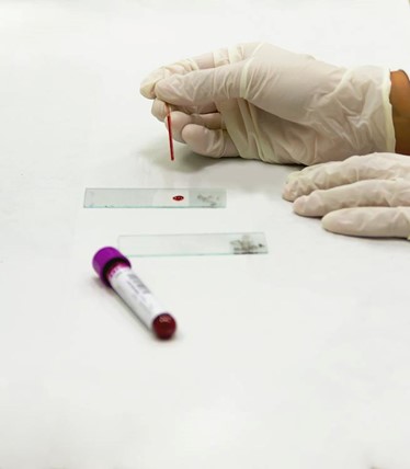 Advancing Detection: Blood Test Breakthrough Identifies Alzheimer’s Brain Changes