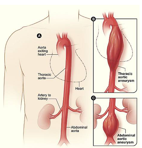 Aneurysms Explored: A Deep Dive into Varieties and Complications