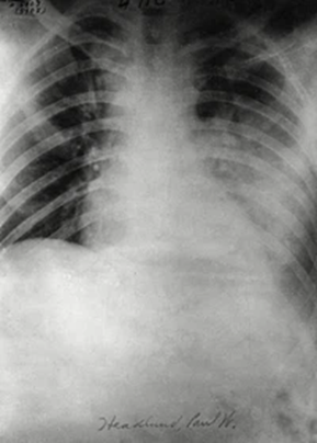 Why Some People Get Sick from TB While Others Don’t—and What It Means for Global Health