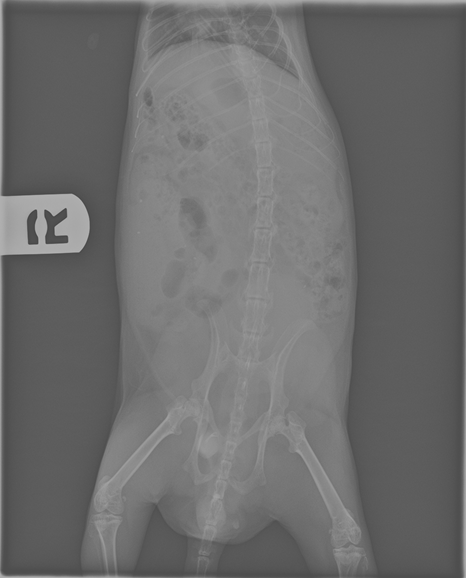 Why Kidney Stone Measurement Needs a High-Tech Makeover