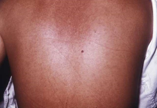 Bever Fever Rash Fever and Rash: When It’s Time to Visit a Doctor